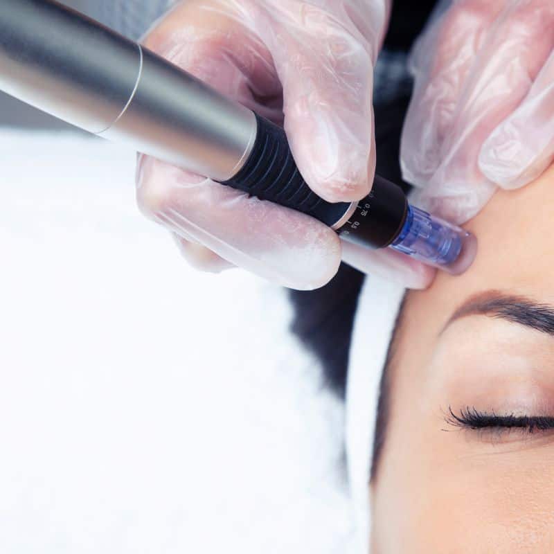 Morpheus8 treatment Sparkhill from Lipo Sculpt - Book in today!