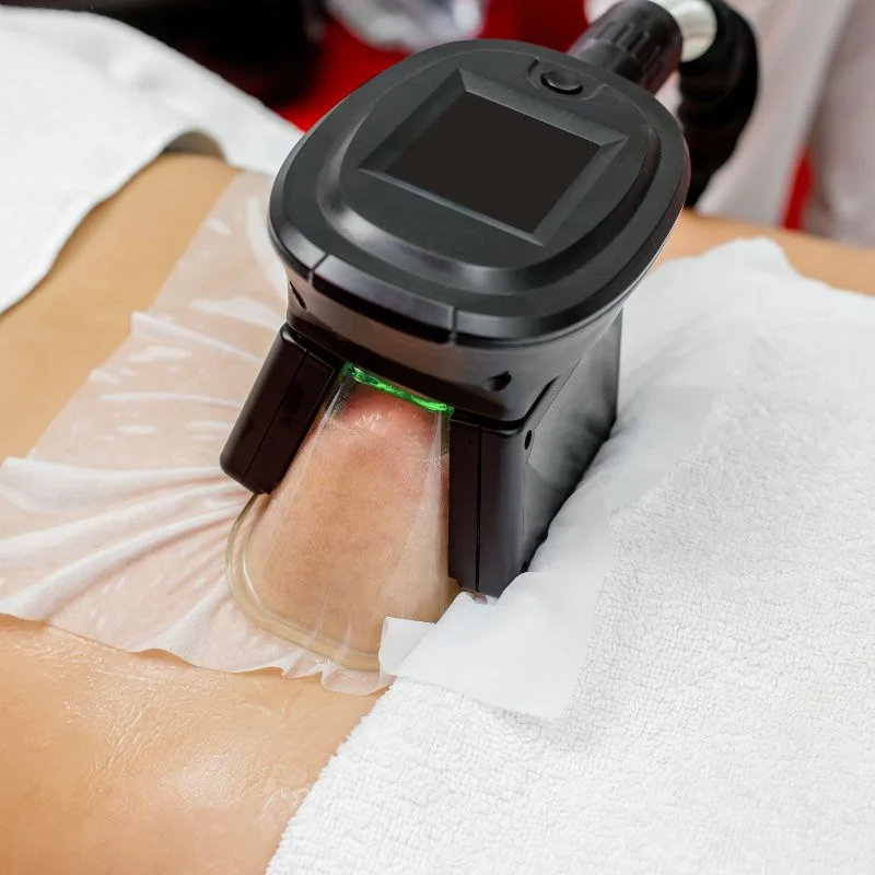 Fat Freezing treatment Sparkhill